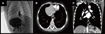 Case report: Joint diagnosis and treatment of intrathoracic gastric duplication with a gastric communication in a child by laparoscopy and gastroscopy